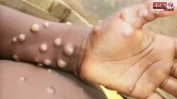 MPox से सुरक्षा के लिए UNICEF ने जारी किया इमरजेंसी टेंडर, WHO ने किया सहयोग