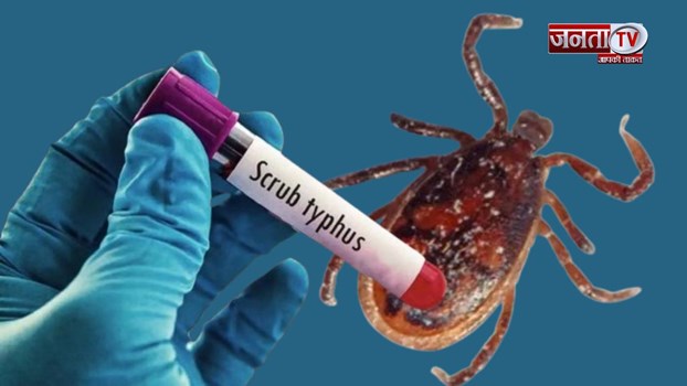 Scrub Typhus: स्क्रब टायफस का कहर, 17 और 25 साल की दो युवितयों की IGMC अस्पताल में हुई मौत